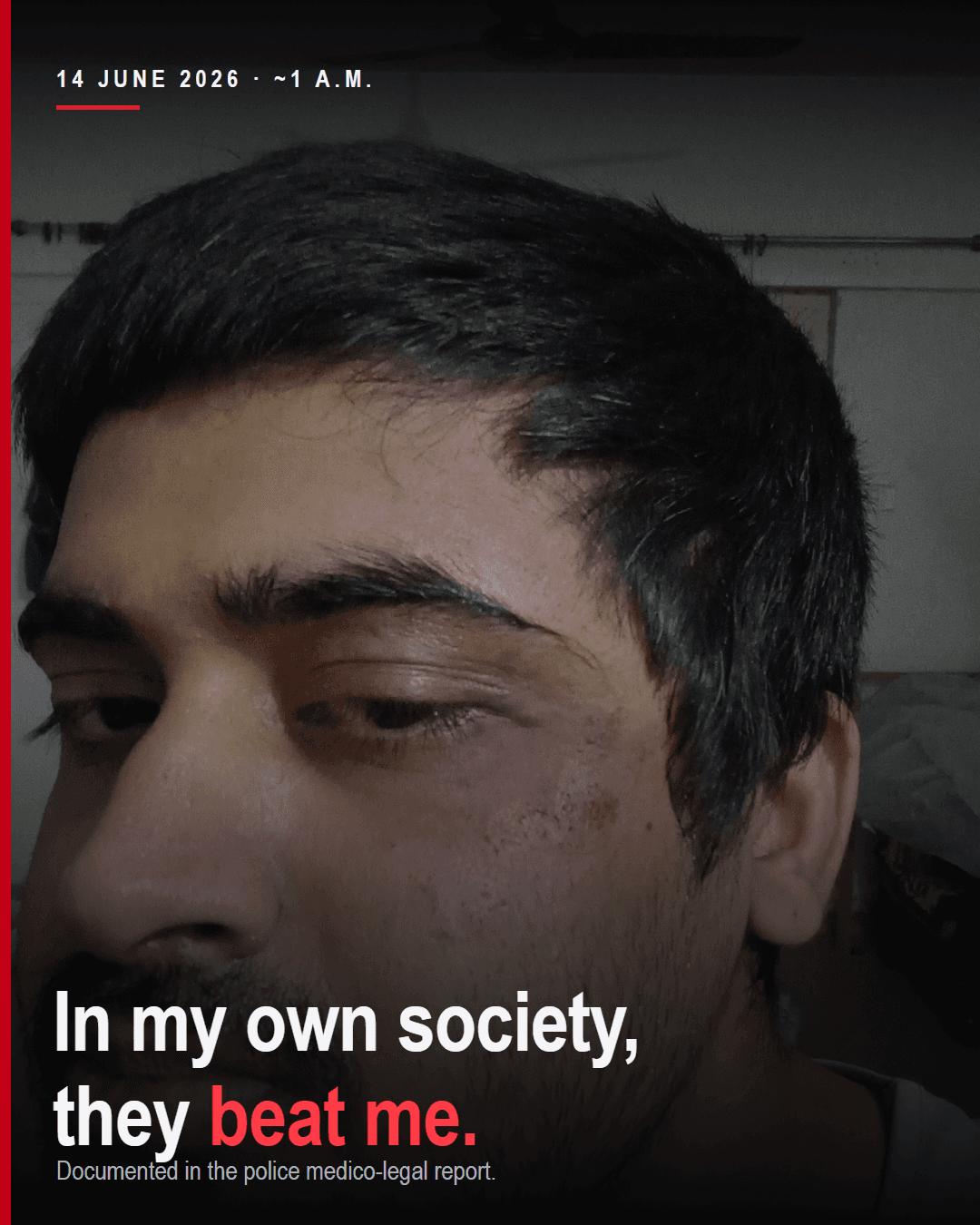 Documented facial injuries from the assault, recorded in an official medico-legal case and a police medical-referral letter.